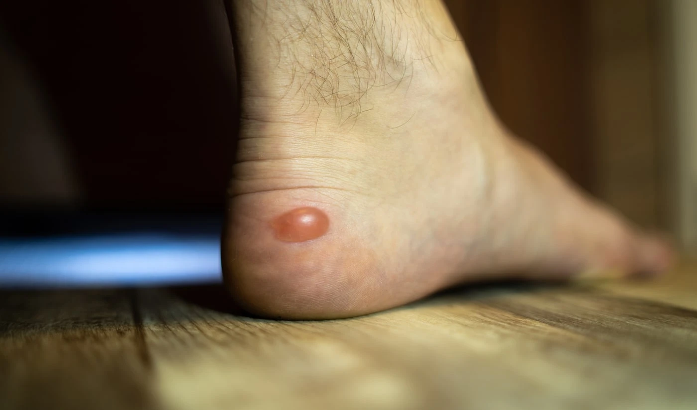Évitez-les ampoules/5 astuces efficaces pour protéger vos pieds